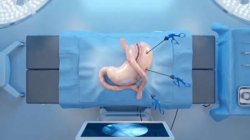 Gastric sleeve surgery procedure showing reduction of stomach size using laparoscopic technique