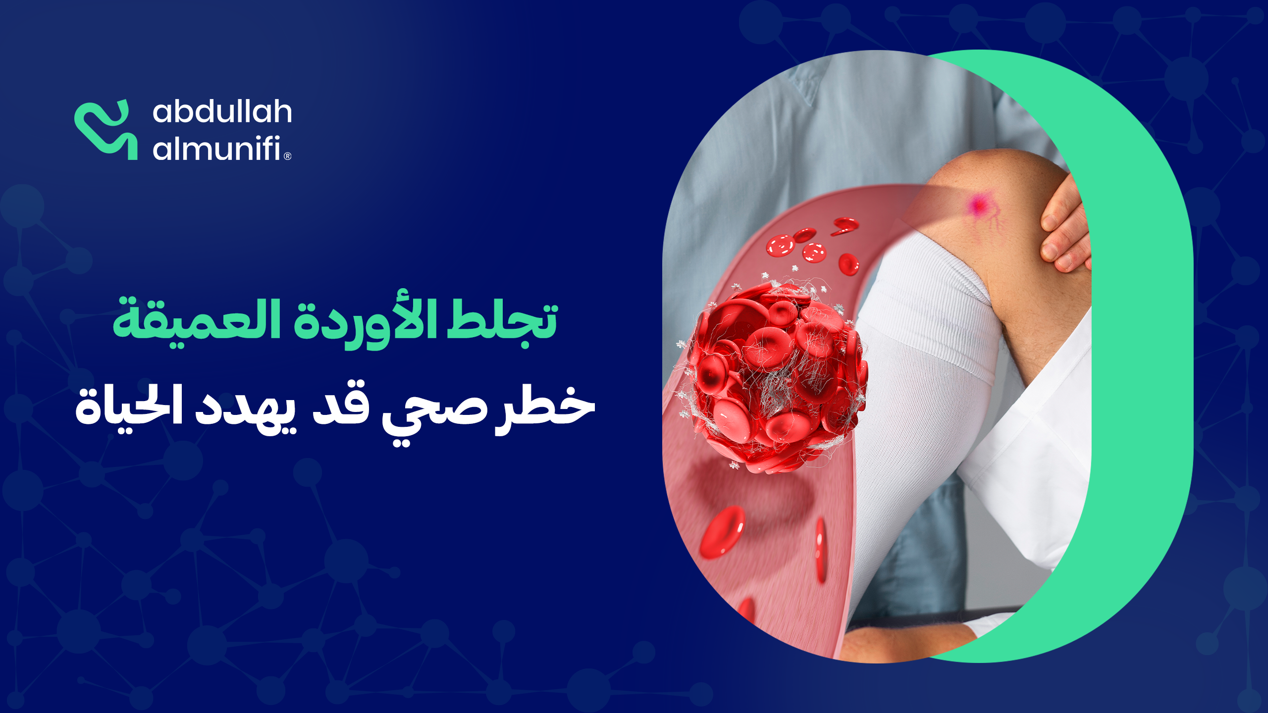 تجلط الأوردة العميقة