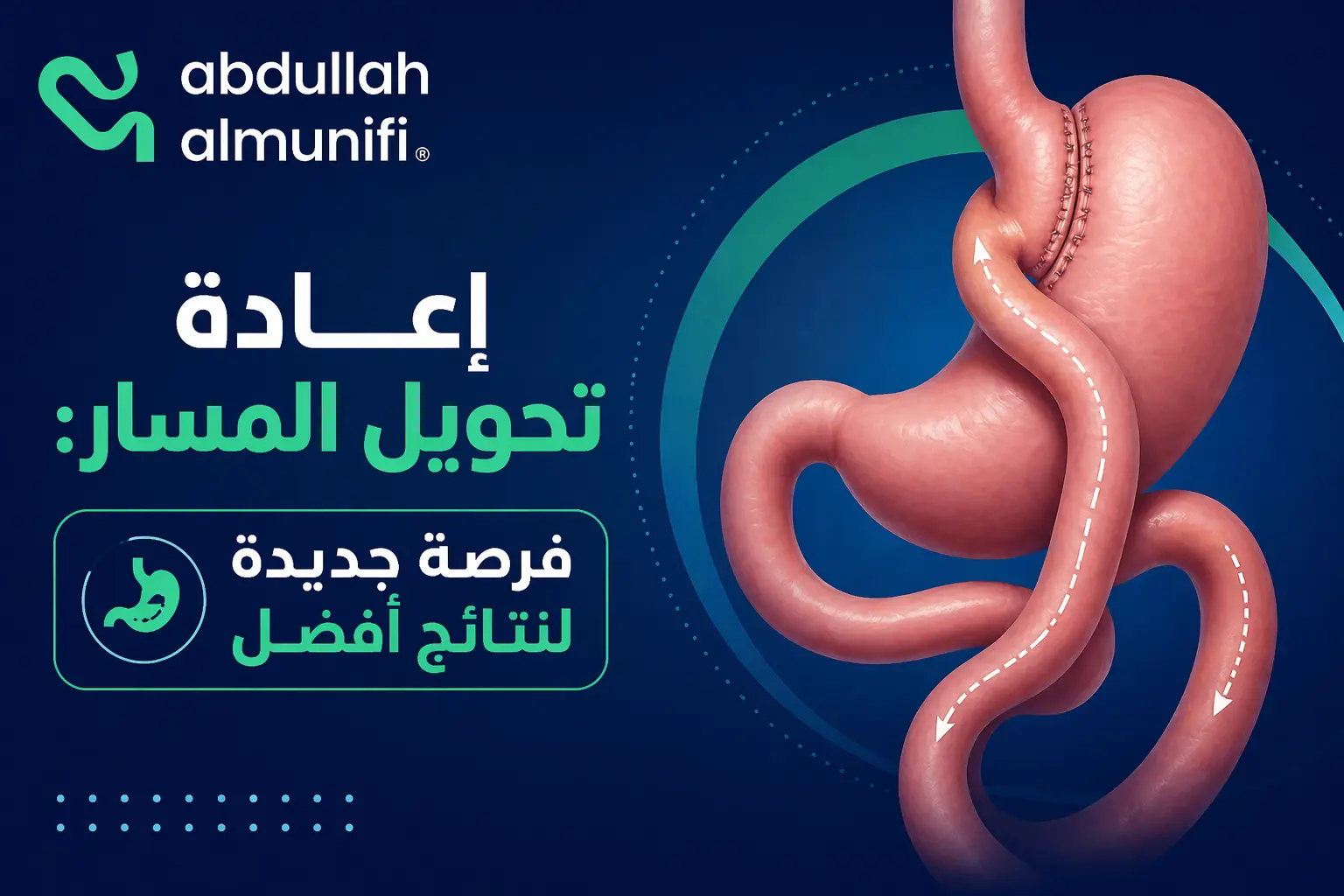 إعادة عملية تحويل مسار المعدة باستخدام تقنيات المناظير المتقدمة لإنقاص الوزن