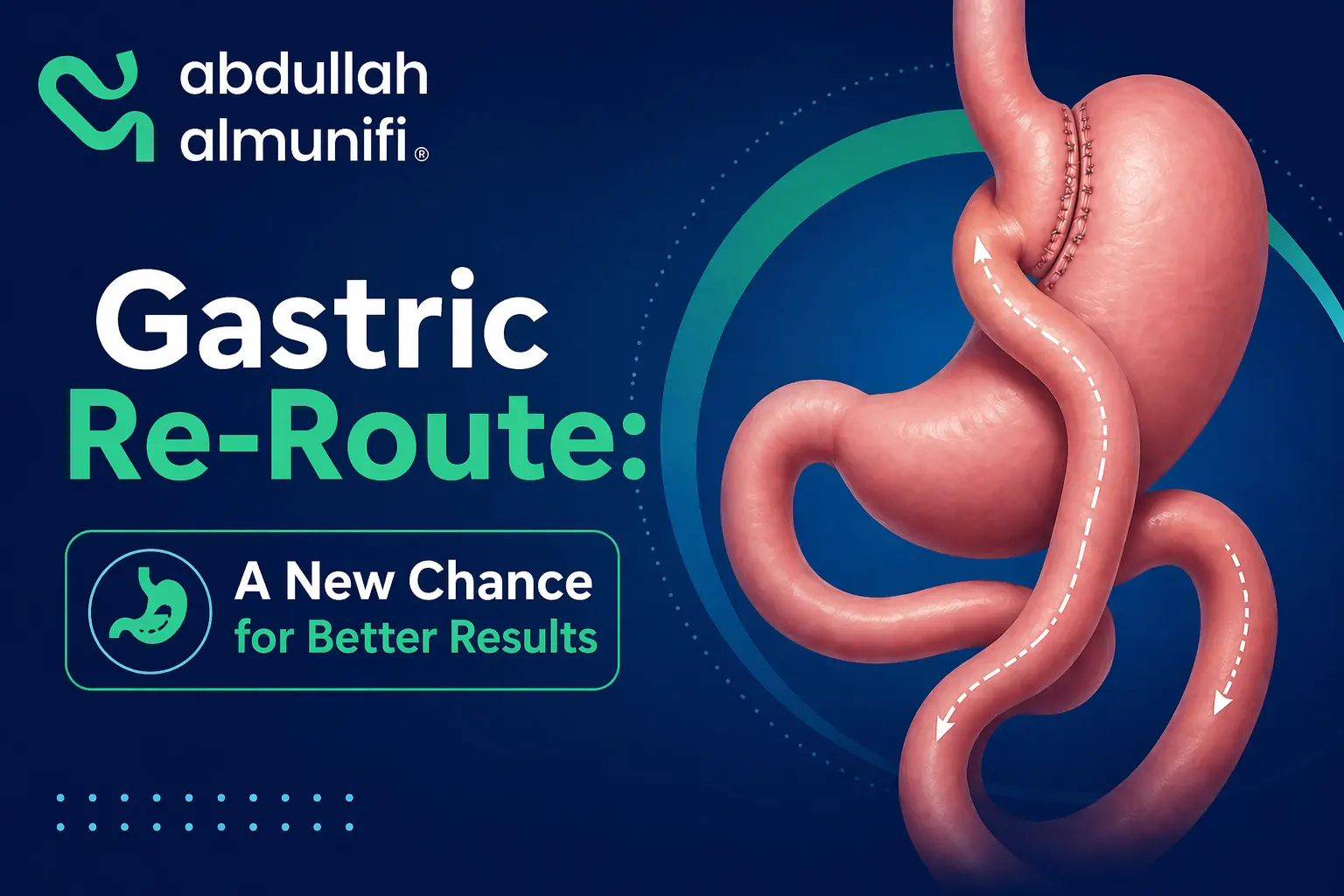 Revision gastric bypass surgery procedure for weight loss with advanced laparoscopic techniques